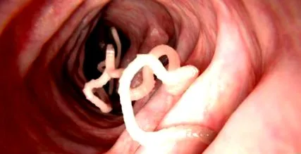 colon