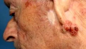 eccrin