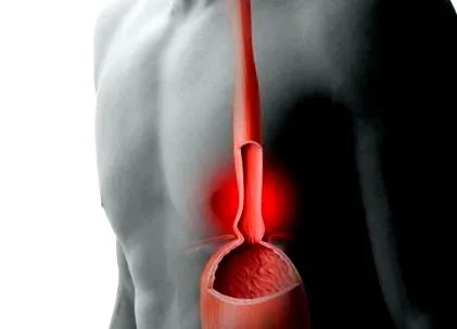 reflux