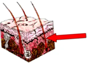 pyoderma
