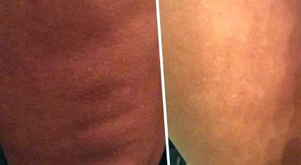 cellulit ellen