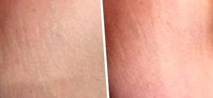 cellulit ellen