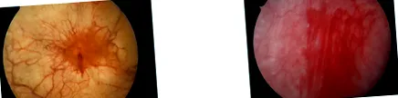interstitialis