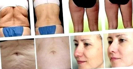 lipo
