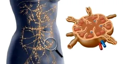 lymphedema