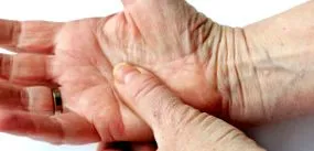 arthritis