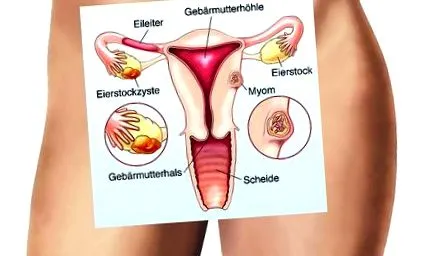 fibroame