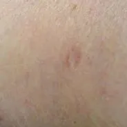 sandriabetes