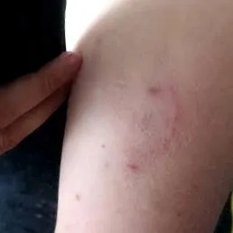 cukorbetegséggel
