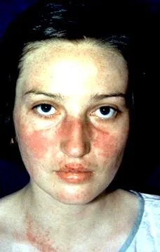 lupus
