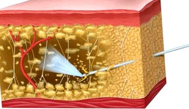 liposukcia