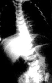 chylothorax