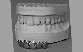thumfart grillzkrone