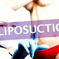 liposucția