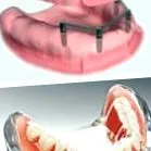 coroanele