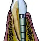 dentare