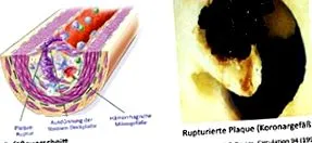 lipid
