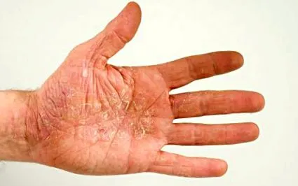 neurodermatitis