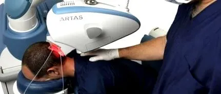artas transplant