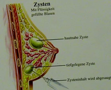 mellciszták