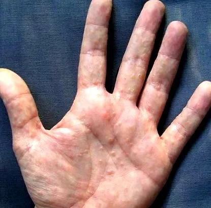 dyshidrosis