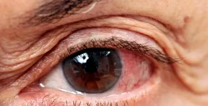 nervului optic
