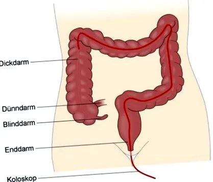 colitis