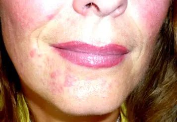 dermatitis