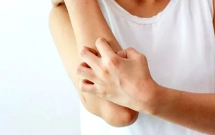 Atópiás dermatitis