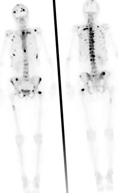 prostată