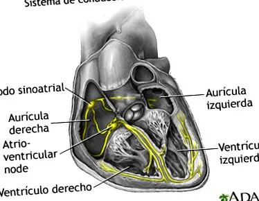 tachycardia