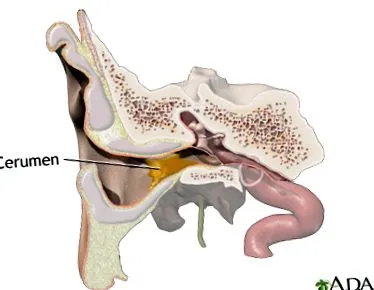 earwax