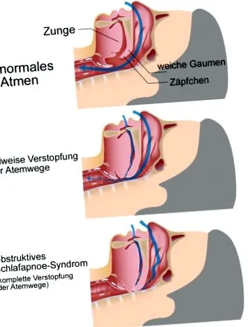 apneea