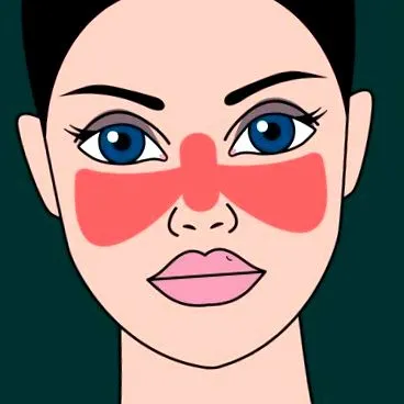 lupus erythematosus