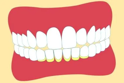 prevenirea