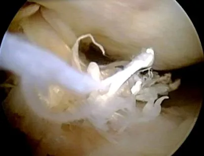 arthrofibrosis