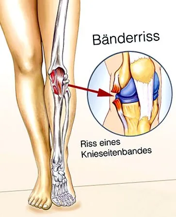 cauze ligament