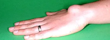 ganglion