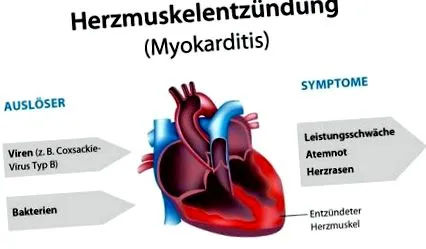 myocarditis