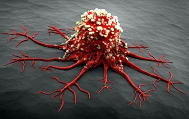 chondrosarcoma