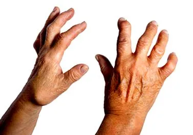 osteoartrita