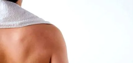 hyperhidrosis