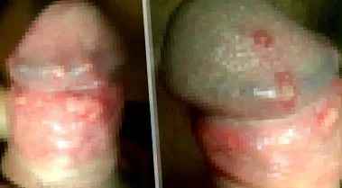 herpesului genital