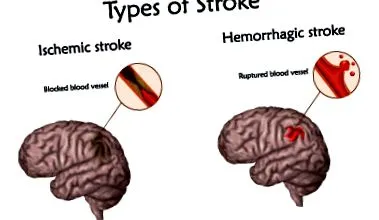 intracerebrală