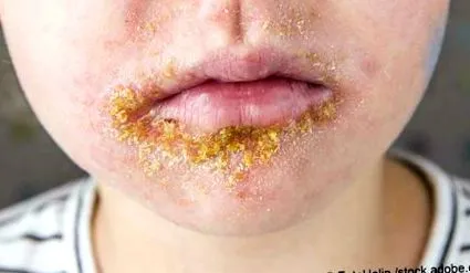 impetigo simptome