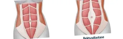 diastasis