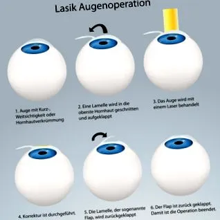 laser tratament