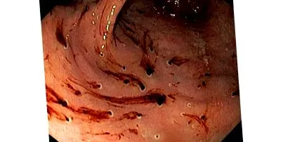 gastric