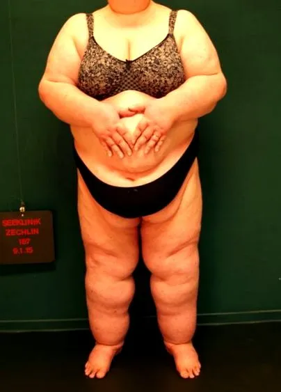 lymphedema