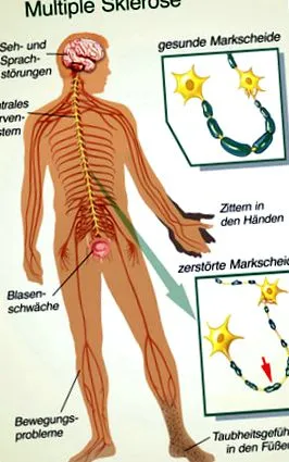 sclerosis multiplex